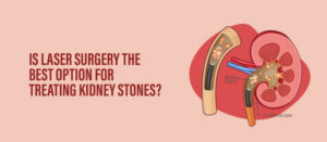Is Laser Surgery the Best Option for Treating Kidney Stones?