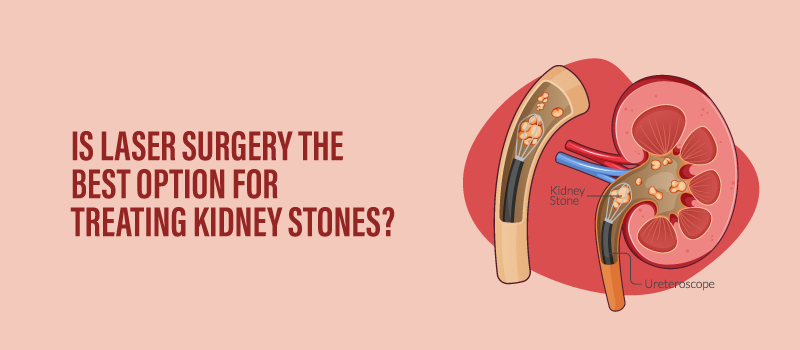 Is Laser Surgery the Best Option for Treating Kidney Stones?