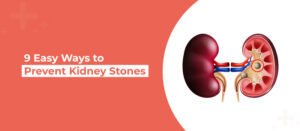 9 Easy Ways to Prevent Kidney Stones