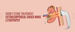 Kidney Stone Treatment: Extracorporeal Shock Wave Lithotripsy