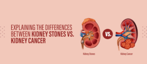 Explaining the Differences Between Kidney Stones vs. Kidney Cancer