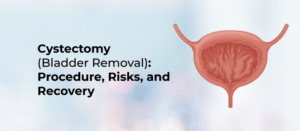 Cystectomy (Bladder Removal): Procedure, Risks, and Recover