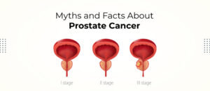 Myths and Facts About Prostate Cancer