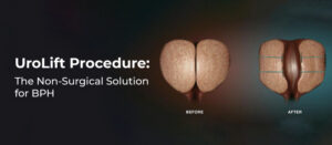 UroLift Procedure: The Non-Surgical Solution for BPH
