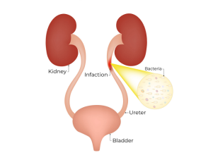 Recurrent Urinary Tract Infections (UTIs)