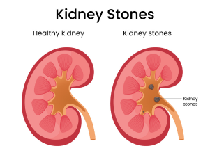 Kidney Stones