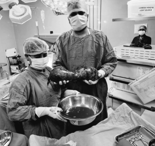 AINU Doctors Successfully Remove a Rare Dumbbell-shaped Giant Testis Tumor