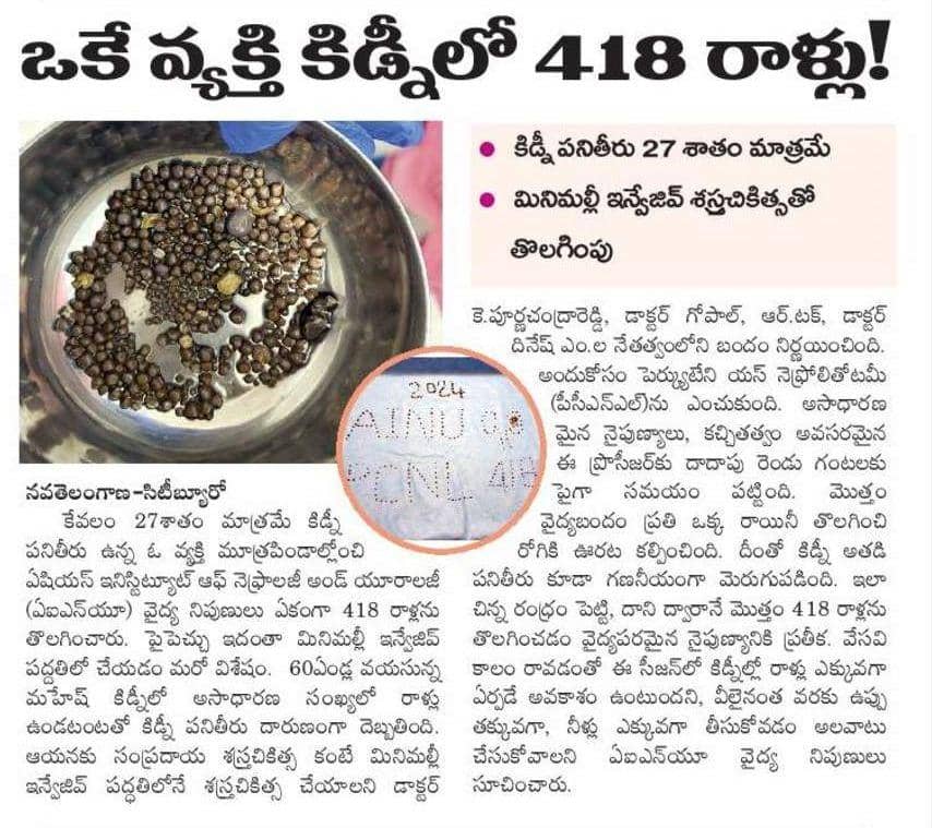 Surgical Milestone: 418 Kidney Stones Removed from Patient with 27% Kidney Function through Minimally Invasive Procedure to Save His Kidneys